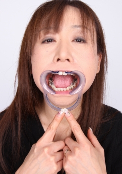 崩壊・銀歯・元歯科助手熟女さんの歯！