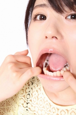 2013年　武藤つぐみの歯