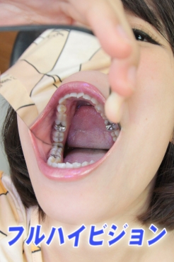 由紀恵ちゃん　放置してた虫歯を治療中