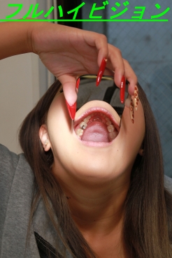 フルハイビジョン【リアル歯科治療】立花みか（19歳）銀歯埋め込み治療映像【銀歯・奇形歯】