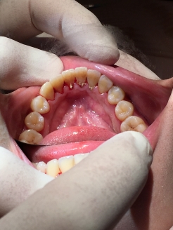 【歯科治療】『歯周病！？歯肉縁下歯石除去』　星野桃子