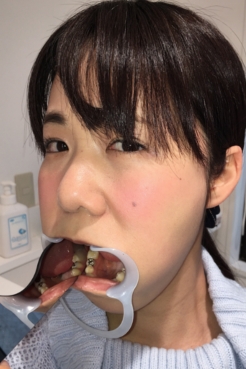 【過去最強虫歯治療】美少女若菜しずく（22歳）銀歯2箇所埋め込み治療