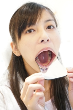 治療史上最強虫歯　平清香（31）【歯観察+虫歯治療+銀歯取外映像】