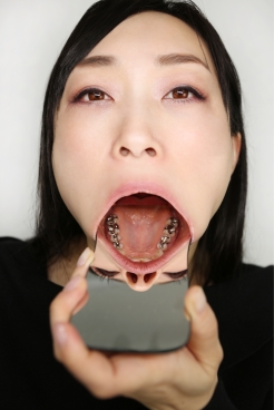 ゆうこ(29)【歯科治療映像】変形親不知を抜歯そしてゲット!!さらには左上4番も掘削治療開始!!