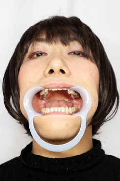 いずみ(26)【歯科治療映像】一気に７本治療中！銀歯装着に向けて準備万全！！