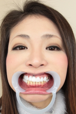 【歯観察】まさみさん(30)銀歯＆セラミックだらけの口内は必見！