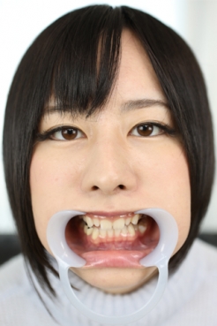 【歯観察】柚希ちゃん(25)銀歯４本と虫歯もあり。変形八重歯も披露！