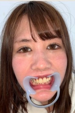 【歯観察】前歯4本全部セラミック治療　かれんのお口の中～咀嚼観察