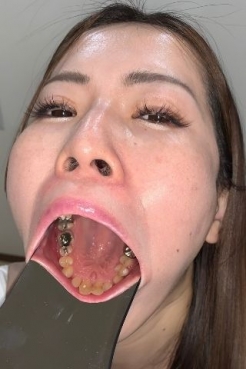 【銀歯治療】押しに弱い女は口内も崩壊！？神経まで達する寸前、右下6番決死の虫歯治療